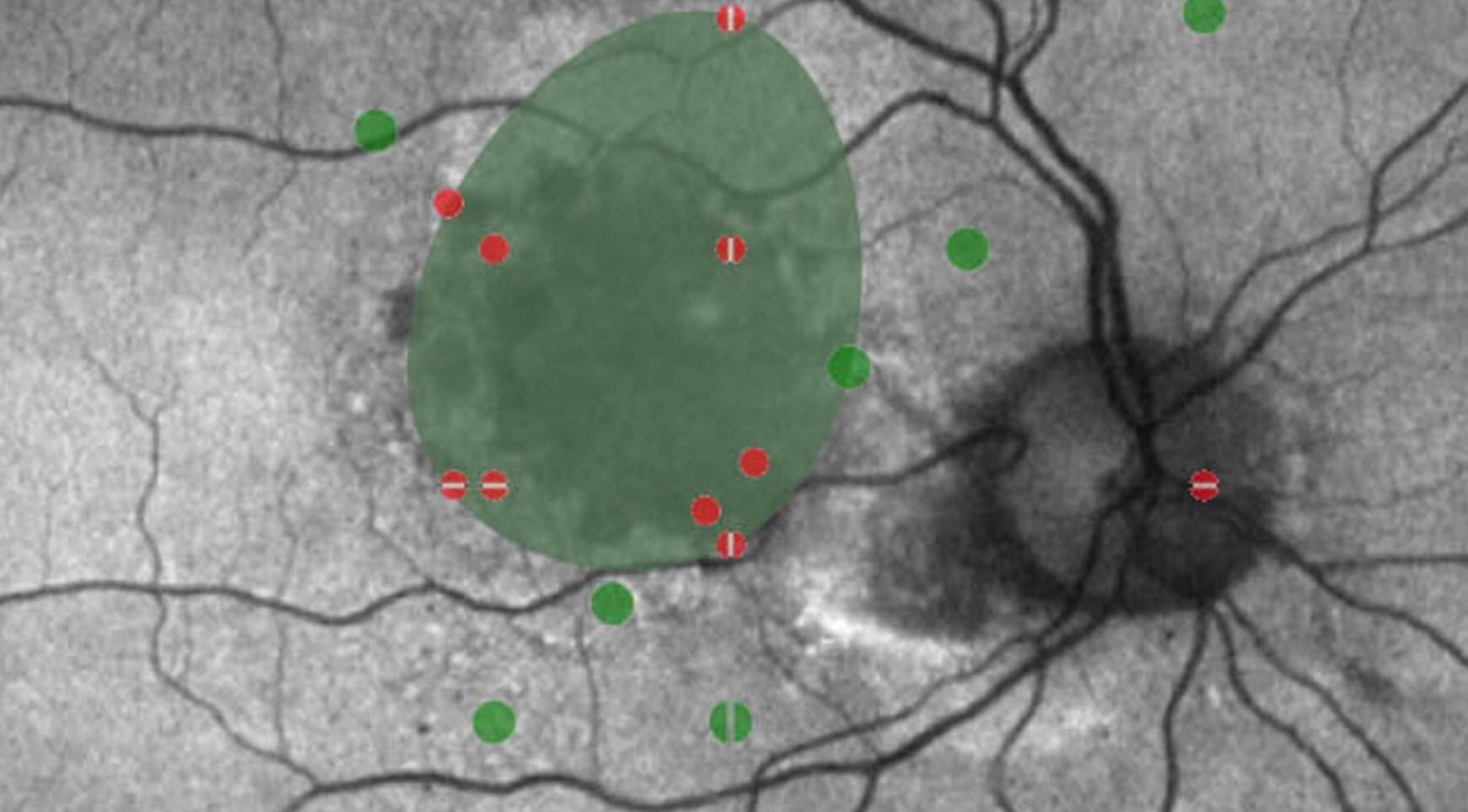 Macula with green area maping scotoma